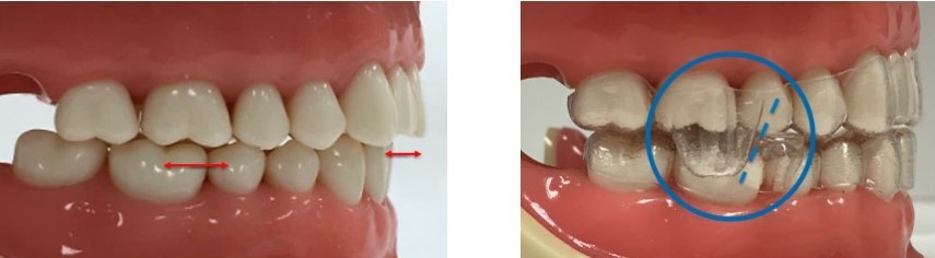 Avanço mandibular Invisalign