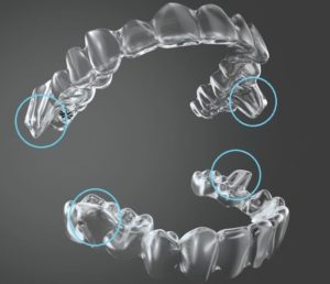 Invisalign em crianças
