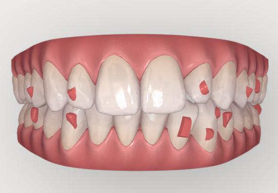 ClinCheck Invisalign